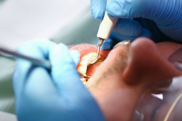 Best Emergency Tooth Extraction in Grantsville, UT